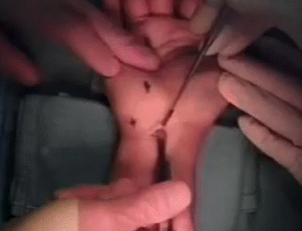 Carpal Tunnel